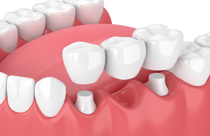 Best Tooth Replacement Options In Singapore
